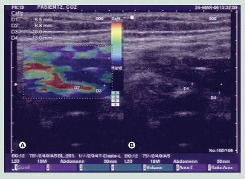 Figure 4. Elastography in Crohn’s disease of the gastrointestinal tract.(A) Elastogram in which the blue color indicates a hard and thickened anterior and posterior gastrointestinal wall. (B) Corresponding grayscale ultrasound image.