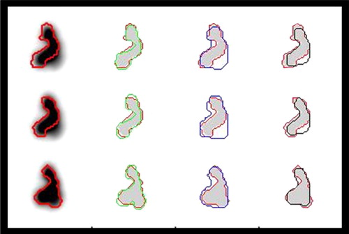 Figure 4. An illustration of the performances of different methods for tumour delineation based on PET is shown. The reference contour (red) is drawn into the PET-images, and as references for delineation based on the Difference of Gaussians (DoG) (green), manual delineation (blue) and 50% of SUVpeak isocontour delineation (black). Moving from the upper to the lower row, three consecutive slices 1 mm apart are shown. The DoG-derived contours follow the reference very closely. Manual drawing was not capable of excluding the contributions from the sources that came into focus in the lower row, and there was a tendency to exclude thin protruding parts of the tumour. IsoSUV delineation in general was imprecise and also excluded the thinner protruding parts.
