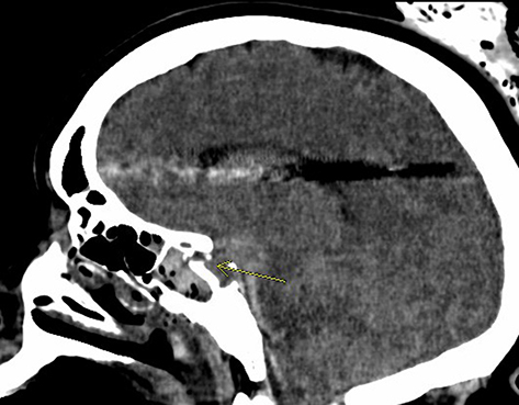 Figure 6 Sagittal view of the head CT. (Yellow arrow: right sided lateral sphenoid wall fracture due to force of penetrating trauma).
