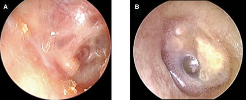 Figure 2. Otoscopic findings of tympanic membrane. The right external auditory canal was expanded (A) and sclerotic lesion was found in the left tympanic membrane (B).