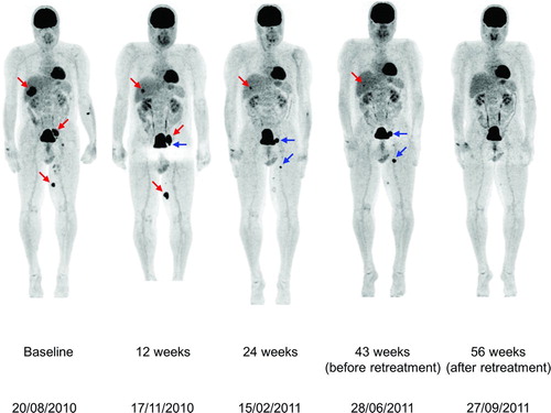 Figure 4  Coronal maximal-intensity-projection PET whole body scans obtained at baseline and Weeks 12, 24, 43, and 56 during therapy with ipilimumab 3 mg/kg in patient D. At baseline, before he started ipilimumab 3 mg/kg, there were 18FDG-avid metastases in the liver, para-iliac lymph node and distally in the inner left upper leg (red arrows). At the first evaluation in Week 12, there was regression of the liver metastasis but increases in the dimensions of (and 18FDG uptake in) the para-iliac lymph node and distal upper leg metastases and the appearance of a new iliaco-femoral lymph node metastatic lesion (blue arrows). Evaluation in Week 24 showed further regression of the liver metastasis and regression of the para-iliac metastasis and the distal metastasis in the left leg with complete loss of 18FDG uptake in these two lesions; there was an increase in size and 18FDG uptake in the iliaco-femoral metastasis and appearance of a new proximal lesion in the left leg. Immediately before retreatment, there was near-complete regression of the liver and para-iliac metastases but further progression of the other three lesions. After retreatment, all lesions further regressed in size with complete loss of 18FDG uptake.