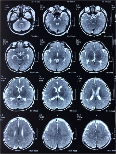 Figure 4. Postoperative head MRI scan (T2) (A boy aged 1 year and 13 days with spontaneous subdural intracranial hemorrhage).