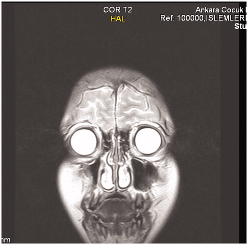 FIGURE 4. Cranial MRI-T2 coronal section.