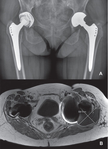 Figure 1. Standard AP radiograph (panel A) and MARS-MRI scan (panel B) 2 years after implantation of the left THA with a double-mobility acetabular component. Note the adequate implant positioning and fixation (A) and a 6 × 9 cm soft tissue mass (B) at the posterolateral side of the left femoral component. On the right, there were no signs of periprosthetic soft tissue reaction.