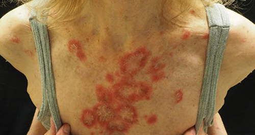 Figure 2 Annular subacute cutaneous lupus erythematosus (SCLE) characterized by polycyclic violaceous annular plaques with trailing scale in photo distributed anatomic sites (eg, upper chest).