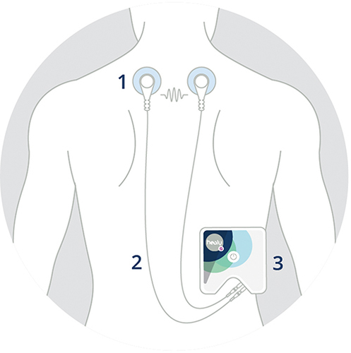 Figure 1 Example of the application of the investigational medical product (Healy device); 1: Adhesive electrodes, 2: Cables, 3: Healy device.