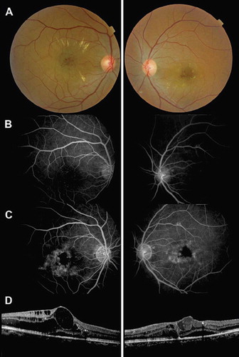 Figure 1 A. Color fundus images 1 month after the initiation of trastuzumab: small hemorrhages and hard exudates were present in the macular area of both eyes. B. Early phase of the fluorescein angiography (FA) showing a significant enlargement of the foveal avascular zone. C. The late-phase of FA showed dye leakage from the perifoveal capillaries. D. Spectral-domain OCT showed bilateral cystic macular edema associated with serous retinal detachment.