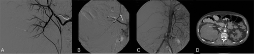 Figure 2.  (A) Control angiogram showing small extravasation of contrast agent from a small polar branch of the right renal artery (white arrow). (B) During coiling, embolization of right segmental renal arteries with preservation of the right inferior adrenal artery (white arrow). The black arrow indicates the microcoils. (C) After embolization, a control aorta angiogram confirmed the occlusion of the embolized arteries. No accessory right renal artery was identified. (D) CT scan in follow-up verified the complete occlusion of segmental renal arteries (black arrow). A patent inferior adrenal artery was also observed (white arrow).