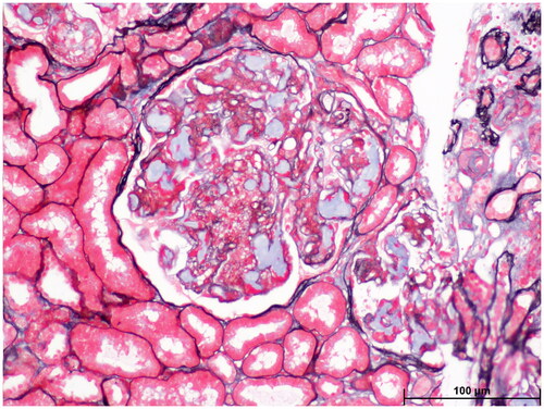 Figure 2. Light microscopy: Eosin staining showed dilated capillary loops exhibiting an eosinophilic lipoprotein thrombus inside the capillary lumens.
