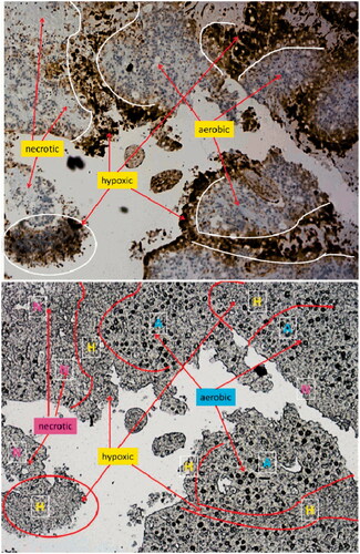 Figure 5. The upper panel shows an excerpt of a pimonidazole stained slide in a tumor that was given continuous low dose-rate irradiation for 25 days. The lower panel shows the same excerpt of the neighboring slide where tritium autoradiography was performed. Direct comparison between the panels was possible, since specific regions and landmarks were recognized in both panels. Aerobic (A), necrotic (N) and hypoxic (H) regions were delineated in the pimonidazole slides and transferred to the autography slides, as indicated. Black spots show uptake of [3H]-valine, thereby visualizing [3H]-valine incorporation into cellular protein. There was no incorporation of [3H]-valine in hypoxic or necrotic regions, as shown in the lower panel. [3H]-valine was well incorporated in the aerobic regions.