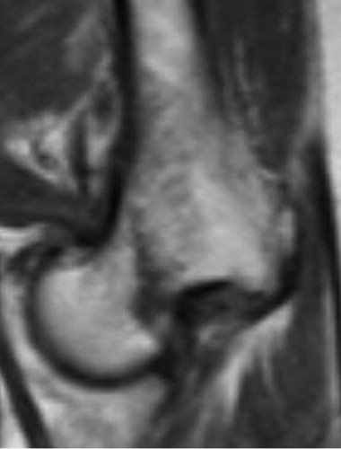 A T1 weighted image with a subcapital femoral neck fracture as a black line with a somewhat vertical progression through the femoral neck.
