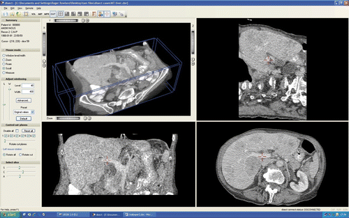 Figure 1. The ‘disect’ user screen showing the liver and the portal vein (red cross).