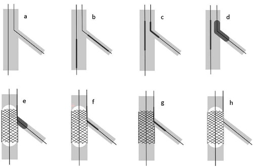 Figure 2. The procedure of the modified active jailed balloon technique. (a) Two guidewires were introduced into both the MV and the SB. (b) The MV was pre-dilated with a balloon first. The MV stent was placed to the distal of the bifurcation lesion before the jailed balloon was placed in SB. (c) The MV stent was withdrawn to an appropriate position that could cover the MV lesion, and the mid-segment of the jailed balloon was adjusted to be located at the ridge of the lesion. (d) The SB balloon was inflated, and the position of the stent was verified by angiography. (e) The MV stent was then inflated. (f) The MV stent balloon was deflated. (g) The jailed balloon was deflated. (h) The MV stent balloon was re-inflated to make the stent appose the vessel wall.