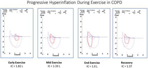 Figure 6 Dynamic hyperinflation during progressive exercise in a patient with COPD. This patient is the same patient as Figures 4 and 5. Panel 1 (early exercise) The flow volume loop (red line) compared to the resting flow volume loop (blue line). Total lung capacity (TLC) is on the left, residual volume (RV) is on the right. Panel 2 (mid exercise) The flow volume loops have moved to the left (towards TLC) consistent with dynamic hyperinflation. Panel 3 (peak exercise) The entire flow volume loop is shifted leftward with a marked reduction in expiratory flow compared to inspiratory flow. Of note, both the peak spontaneous expiratory and inspiratory flow rates at peak exercise approach that were obtained pre-exercise during the resting spirometry. All of these changes begin to resolve in early recovery (panel 4).