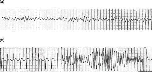 Fig. 2.  a) strip showing ventricular dysrhythmias and b) continuation of same strip with evidence of torsades de pointes.