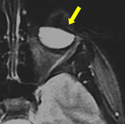 Figure 3 Iron-particle-related susceptibility artifact in mascara indicated by yellow solid arrow [Courtesy Allen D Elster, MRIQuestions.com].Citation21