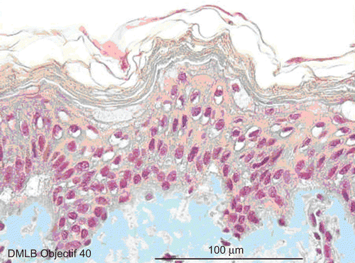 Figure 8.  Skin histological aspect at 5 min after a 20-sec exposure to 30 µL of 70% hydrofluoric acid (HF). The same lesions as those detected after 4 min were observed in the epidermis and papillary dermis. However, as the HF had penetrated into the reticular dermis, slightly pyknotic nuclei were observed in cells in this deepest layer.