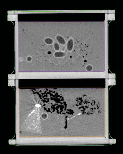 Figure 2. A CT image of the two phantom sections used also showing the delineation into a Body structure, the upper section (Box 1) and lower section (Box 2). In the upper section the fish oil capsules are clearly visible along with small air encapsulations. The bright area in the left side of the lower section is a part of pre-hardened polyurethane containing a solution of BaSO4.