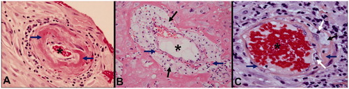 Figure 1. Acute atherosis in the decidual segment of spiral arteries (Hematoxylin and Eosin, ×400). (A) Fibrinoid necrosis (blue arrow) and few chronic inflammatory cells within the vessel wall but no macrophages; (B) mainly lipid-laden macrophages (black arrows) with minor fibrinoid necrosis (blue arrow) in the vessel wall and (C) fibrinoid necrosis (blue arrow) with lipid-laden macrophages (black arrow) as well as chronic inflammatory cells (white arrows) in the vessel wall and perivascular areas. * Lumen of spiral artery.