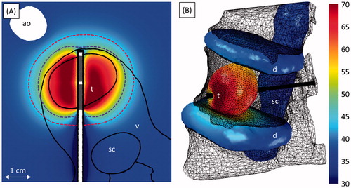 Figure 9. Ablation of an osteolytic tumour invading the anterior portion of the L1 vertebral body (case 7). (A) Temperature (°C) at the end of heating in an axial slice through the applicator. The 240 (violet, inner dashed line) and 6 (crimson, outer dashed line) EM43 °C contours 10 min after treatment, as well as transducer positions (grey) are also shown. (B) The temperature (°C) on the spinal canal, intervertebral discs, and tumour at the end of heating. The applicator (black cylinder) and bone surface (black mesh) are also shown. The locations of the tumour (t), vertebrae (v), spinal canal (sc), intervertebral discs (d), and aorta (ao) are indicated in the figures.
