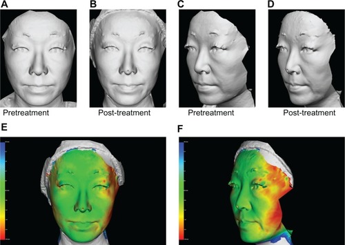 Figure 4 A 49-year-old Japanese woman (A and C) pretreatment and (B and D) 60 days post-treatment, and (E and F) three-dimensional color schematic representation. Only one treatment was performed with four passes at 42 J/cm2 (80 shots). Significant improvements were noted in the gray image and three-dimensional color schematic representation. Volume reduction was 5.248 mL.