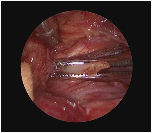 Figure 2. Left styloid with tonsil clamp following dissection of all attachments.