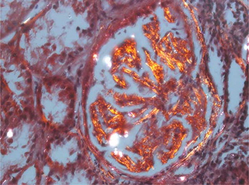 Figure 2. Renal biopsy.Note: Congo-red stain reveals apple-green birefringence under polarized light.
