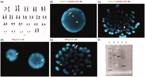 Figure 1. Molecular analysis of white blood cell DNA performed at RUMC. The karyotype did not show the expected t(15;17) rearrangement (a), but interphase and metaphase FISH revealed separation of the green and orange RARA break apart (BA) probe signals from their location on chromosome 17 (white arrows, b and c). Interphase and metaphase FISH with single fusion (SF) PML and RARA probes revealed the movement of RARA to chromosome 15 at the location of PML as a small yellow fusion signal (white arrows, d and e). The PML-RARA fusion gene was detected by reverse transcriptase PCR using primers to exon 3 and exon 6 of the PML gene and reverse primer to exon 3 of RARA (f: Lane 1, molecular weight standard, lane 2 PML exon 6 forward primer, lane 3 PML exon 3 forward primer lane 4, RARA exon 2 forward primer, lane 5 reagent blank). The major PCR product detected at about 500 bp (starred, lane 3) contained exons 3–6 of the PML gene.
