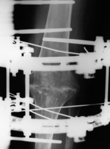 Figure 1. Anteroposterior radiograph showing trabecular fusion across the entire length of the arthrodesis.