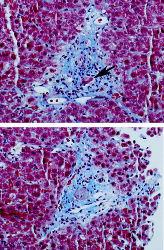 Figure 2.  Liver biopsy, photographs taken of Masson trichrome-stained slides at 100× original magnification. 2a) Bile duct injury: this photograph shows a complete portal triad demonstrating bile duct injury. The bile duct (arrow) shows distortion of the duct with loss of nuclei. In this injured duct, only two nuclei remain. The hepatic artery branch is just above the duct cross section. 2b) Bile duct loss: this photograph shows an artery that is similar in appearance to the artery in Figure 2a (it is the structure in the middle of the portal tract in both cases). But, in contrast to the other photo, there is no bile duct cross-section in this portal tract, representing destruction of the bile duct.