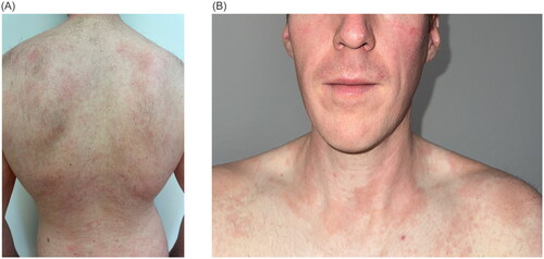 Figure 1. Clinical presentation of severe AD prior to the initiation of systemic therapy with erythematous, dry skin and scratch marks on the back (A) and neck (B). the SCORAD (SCORing atopic dermatitis) was 65.