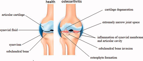 Figure 2. Schematic representation of healthy knee joint structure and pathological changes of knee osteoarthritis.
