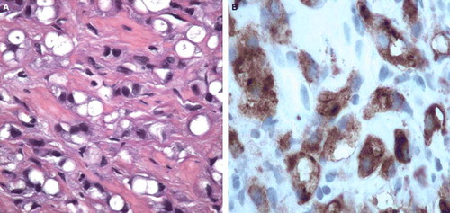 Figure 1.  (A) Specimen with HE-staining of tumour cells. (B) Specimen staining positively for PSA and PAP.