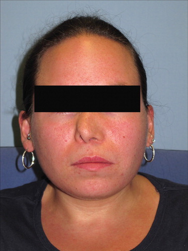 Figure 1. Frontal view of the patient with nasal breathing impairment due to nasal deviation caused by a deviated septum.