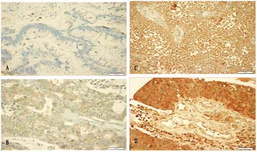 Figure 1. Immunohistochemical staining of cytoplasmic TIMP3 at 40X magnification: (A) Negative cytoplasmic expression, (B) Weak expression, (C) Moderate cytoplasmic expression, (D) Strong cytoplasmic expression