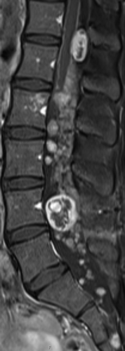Figure 2. MRI of lumbar spine 4 months after the end of bevacizumab treatment.