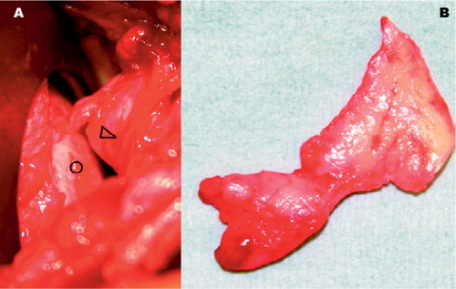 Figure 3. Intraoperative photographs. A: detached labrum (arrowhead) between humeral head (open circle) and glenoid, obscuring the glenoid surface. B: specimen of excised labrum.