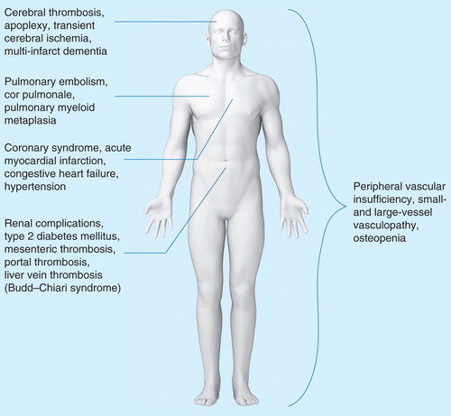 Figure 1. The assortment of comorbidities observed in patients with MPNs. Patients with MPNs display a variety of comorbidities that severely impact patient quality of life and survival. The increased morbidity and mortality in the MPNs are significantly affected by cardiovascular, pulmonary and abdominal complications as well as more global features including peripheral vascular insufficiency and an increased risk of developing fractures. A number of the listed comorbidities are related to the chronic inflammatory state that is associated with the MPNs and progression of disease.