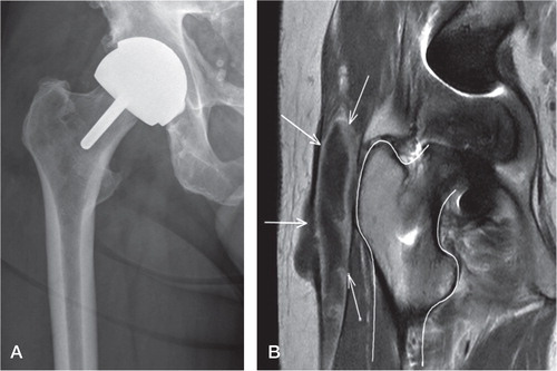 Figure 1. A radiograph (panel A) and an MRI image (panel B) of a BHR hip with a pseudotumor.