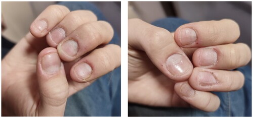 Figure 6. Week 24 resolution of nails psoriasis.