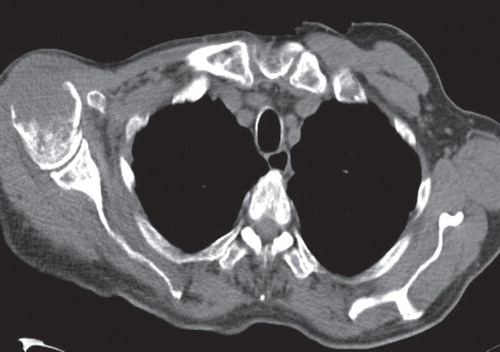 Figure 3. Computed tomography showing destruction of the proximal humerus by a large osteolytic lesion. There is soft tissue plasmacytoma located on the anterior chest wall and partial destruction of the sternum.