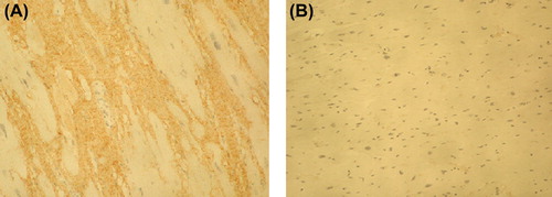 Figure 4. Immunohistochemical staining of PIIINP in myocardium of lamin A/C mutation case (A) and in control case (B). Magnification × 200. The amount of PIIINP (stained brown) was slightly increased in the IMF case in comparison with the control case.