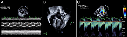 Figure 5 Signs of pulmonary over-circulation. (A) Dilated left atrium measured by M-mode. This LA:Ao >2 is severe left atrial dilation. (B) LV dilation demonstrated by a globular appearance of the heart on an apical 4-chamber view. (C) Forward flow in the LPA indicates PDA shunting during diastole.