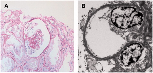 Figure 2. The second allograft biopsy on day 144 after transplantation showed a glomerulus with focal segmental sclerosis on light microscopy (A). Prominent foot process effacement of podocytes was also noted on electron microscopy (B).