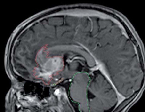 Figure 1. MR scanning for fusion with dose planning CT slice showing the tumour close to the organs at risk.