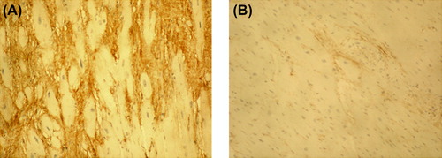 Figure 2. Immunohistochemical staining of PINP in myocardium of idiopathic fibrosis case (A) and in control case (B). Magnification × 200. The amount of PINP (stained brown) was increased in the fibrotic tissue of the IMF case in comparison with control sample.