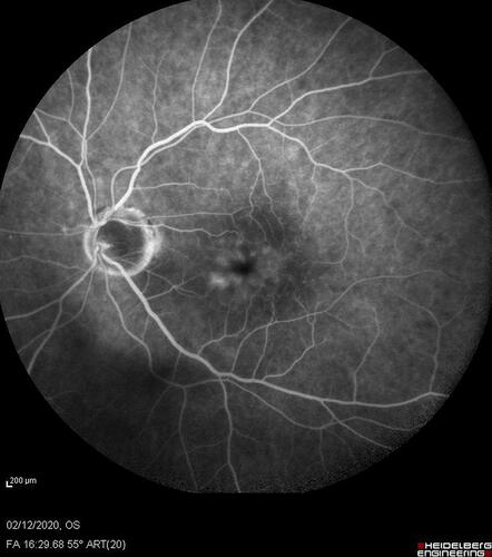 Figure 5 Retinal angiography of a left eye affected by Irvine Gass syndrome. Macular and parapapillary (temporal edge) edema after cataract surgery in a patient suffering from chronic glaucoma with excavated and pale optic disc.