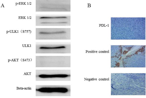 Figure 3. Molecular analysis of the biopsy tissue from lung metastasis. (A) The phosphorylation of ERK1/2 and AKT（S473）was weak in the metastatic tissue，and the phosphorylation of ULK-1 S757 was relatively strong. (B) The PDL-1 expression was negative in the biopsy tissue of lung metastases (IHC 10 × 10).