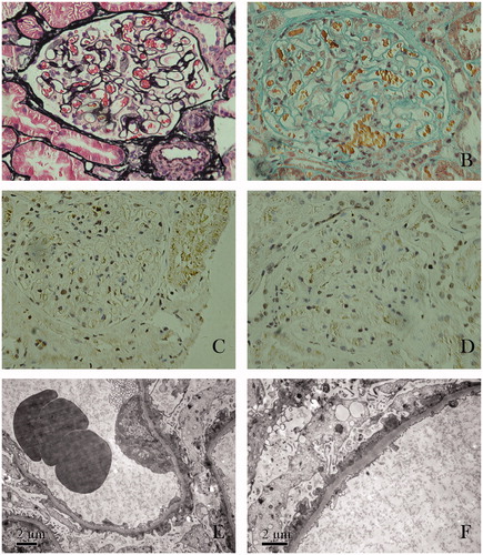 Figure 1. Renal biopsy findings. (A) Glomerular basement membranes appeared uniformly thickened without spikes (stained by periodic methenamine silver, original magnification ×400). (B) Tiny fuchsinophilic grains deposits along the outer aspect of the glomerular basement membranes (stained with Masson’s trichrome, original magnification ×400). (C) Immunoglobulin G subclasses IgG1 deposited along the glomerular capillary wall (stained immunohistochemically, original magnification ×400). (D) Immunoglobulin G subclasses IgG3 deposited along the glomerular capillary wall (stained immunohistochemically, original magnification ×400). (E) Effacement and fusion of epithelial cell foot processes (electron microscopy; original magnification ×8000). (F) Presence of subepithelial immune complex deposits (electron microscopy; original magnification ×10,000).