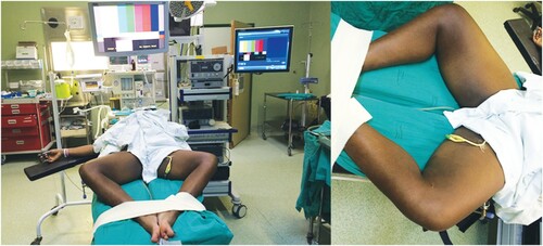 Figure 1: Room setting, with laparoscopy stack placed at the patient’s head, with patient’s thighs abducted and internally rotated to access femoral triangle.